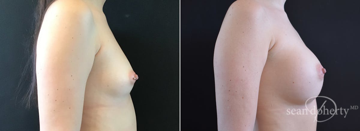 Breast Augmentation  Before & After Gallery - Patient 244166 - Image 3
