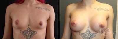 Breast Augmentation Before & After Gallery - Patient 834868 - Image 1
