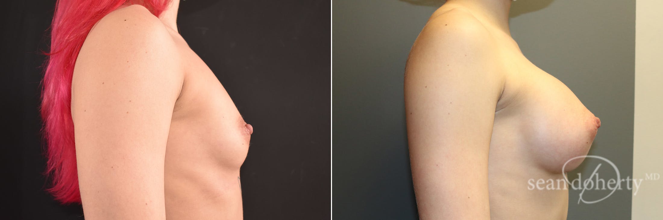 Breast Augmentation Before & After Gallery - Patient 834868 - Image 3