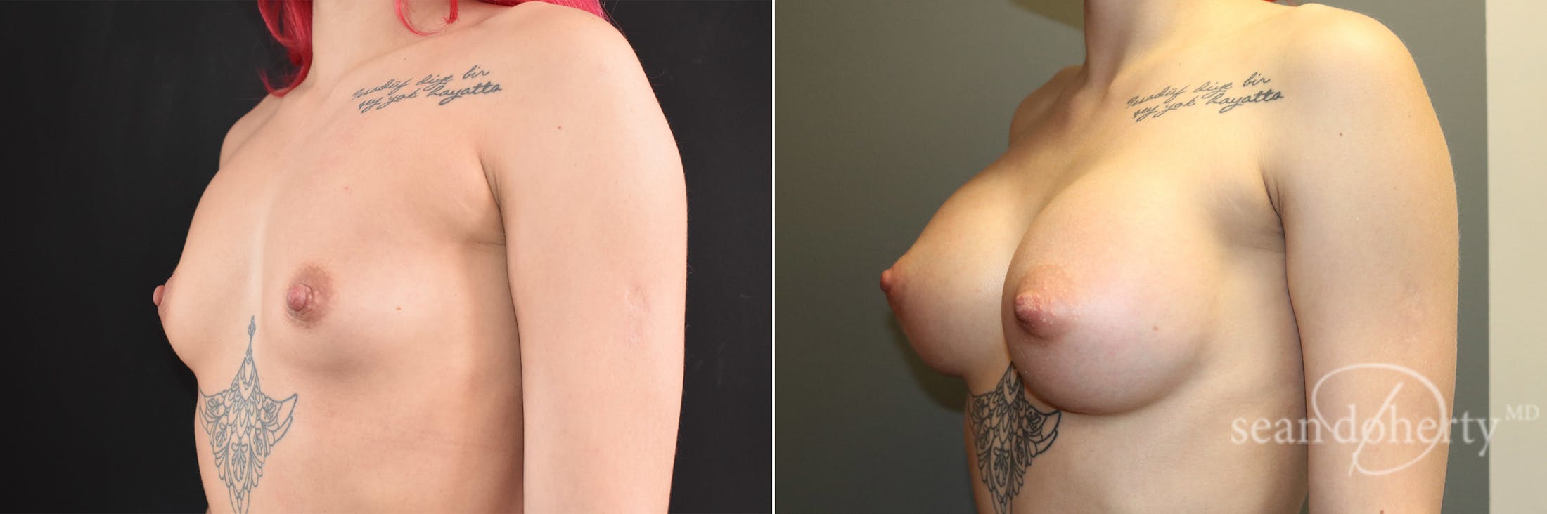 Breast Augmentation Before & After Gallery - Patient 834868 - Image 2