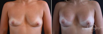 Breast Augmentation Before & After Gallery - Patient 313729 - Image 1