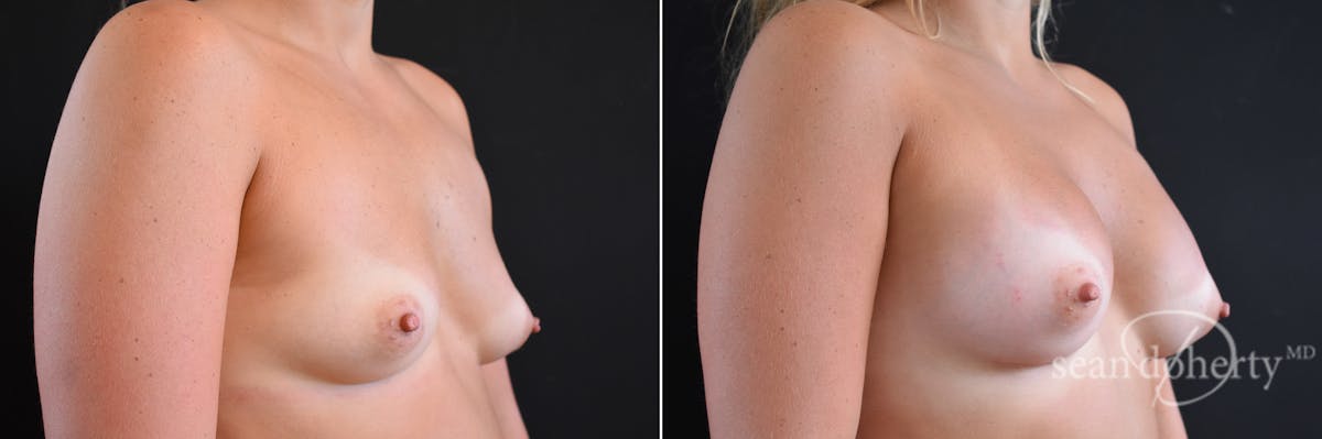 Breast Augmentation Before & After Gallery - Patient 313729 - Image 2