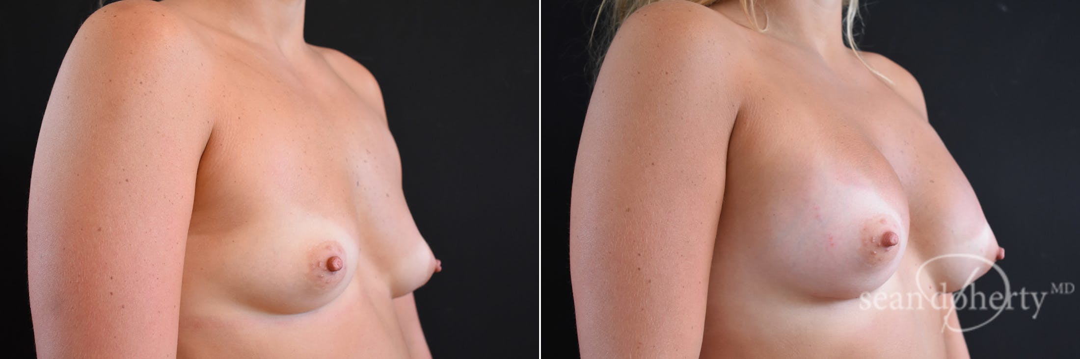 Breast Augmentation Before & After Gallery - Patient 313729 - Image 2