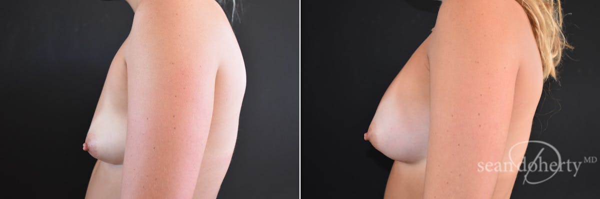 Breast Augmentation Before & After Gallery - Patient 313729 - Image 3