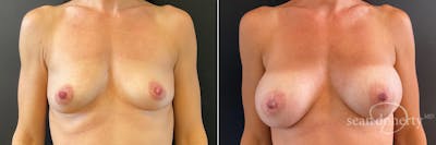 Breast Augmentation Before & After Gallery - Patient 202626 - Image 1