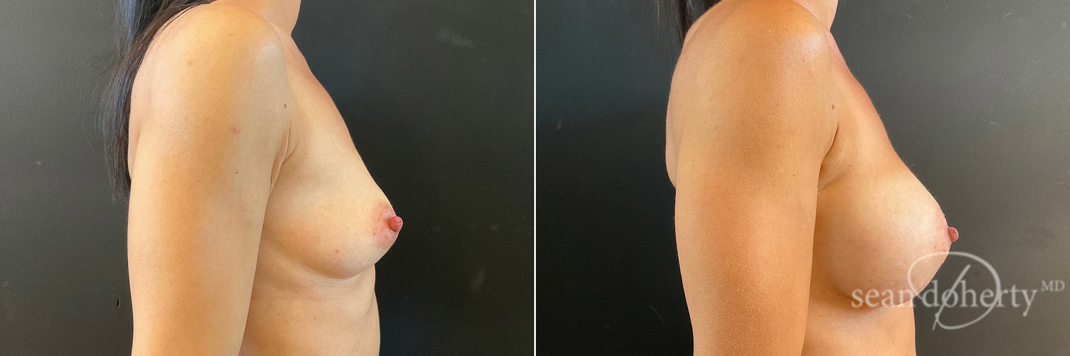 Breast Augmentation Before & After Gallery - Patient 202626 - Image 3