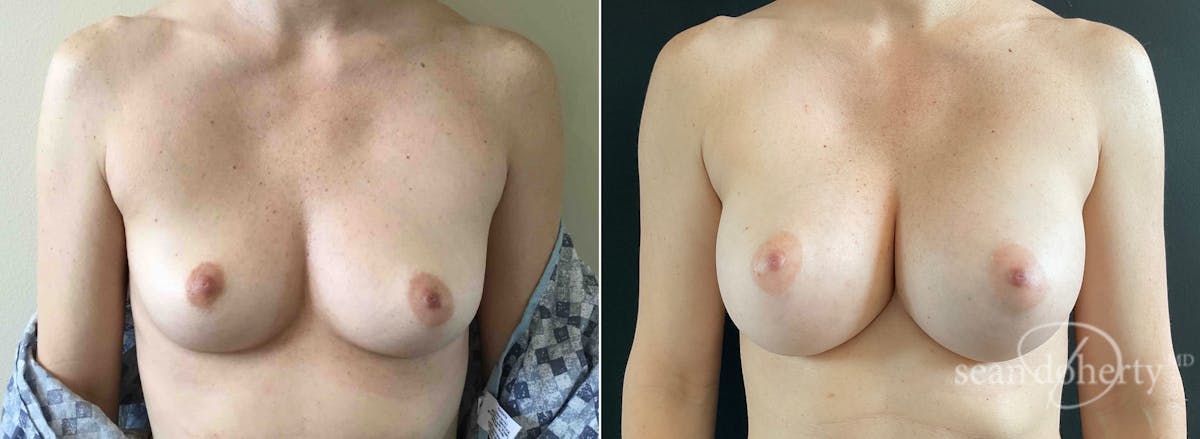 Breast Augmentation Before & After Gallery - Patient 186630 - Image 1