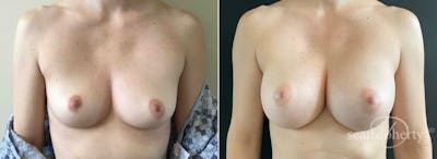 Breast Augmentation Before & After Gallery - Patient 186630 - Image 1