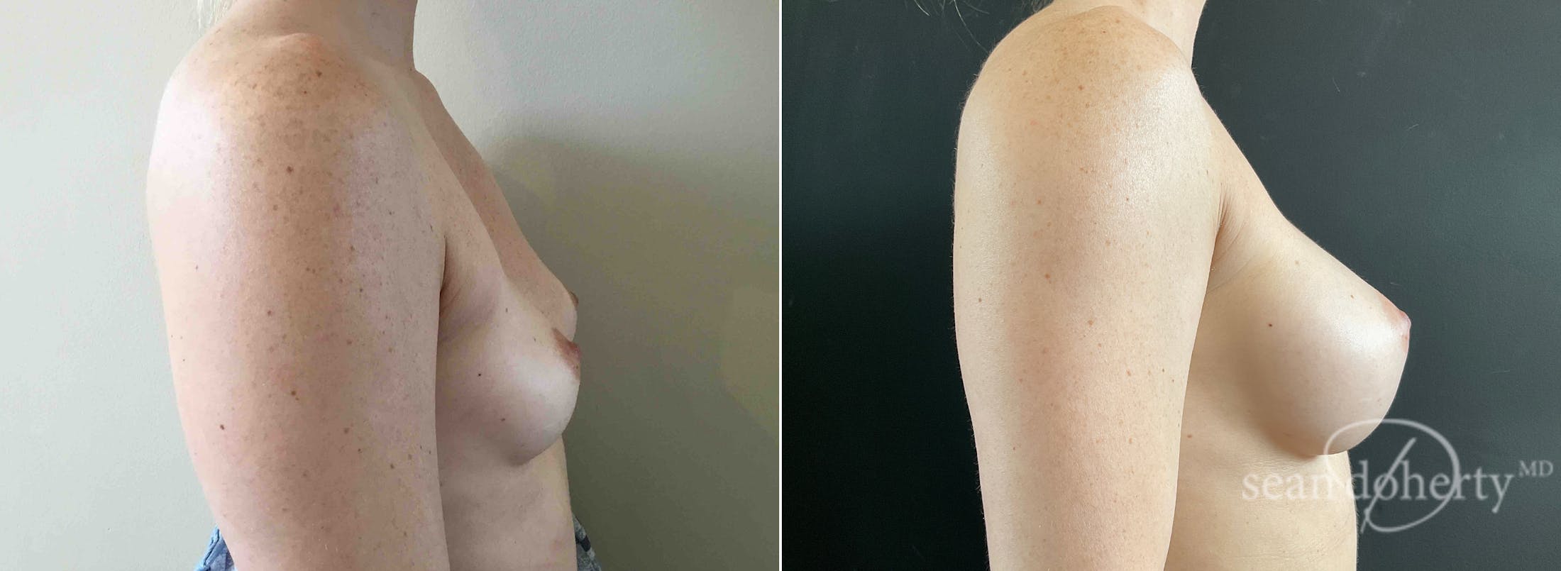 Breast Augmentation Before & After Gallery - Patient 186630 - Image 2