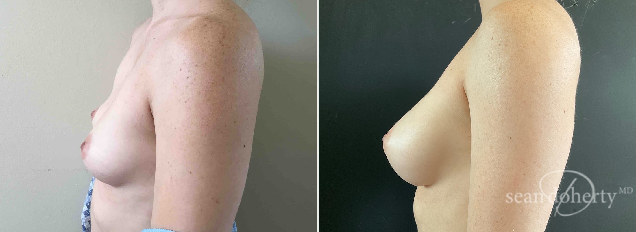 Breast Augmentation Before & After Gallery - Patient 186630 - Image 3