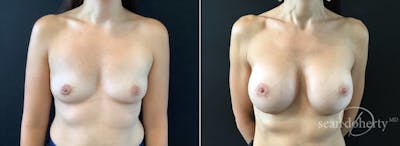 Breast Augmentation Before & After Gallery - Patient 407708 - Image 1