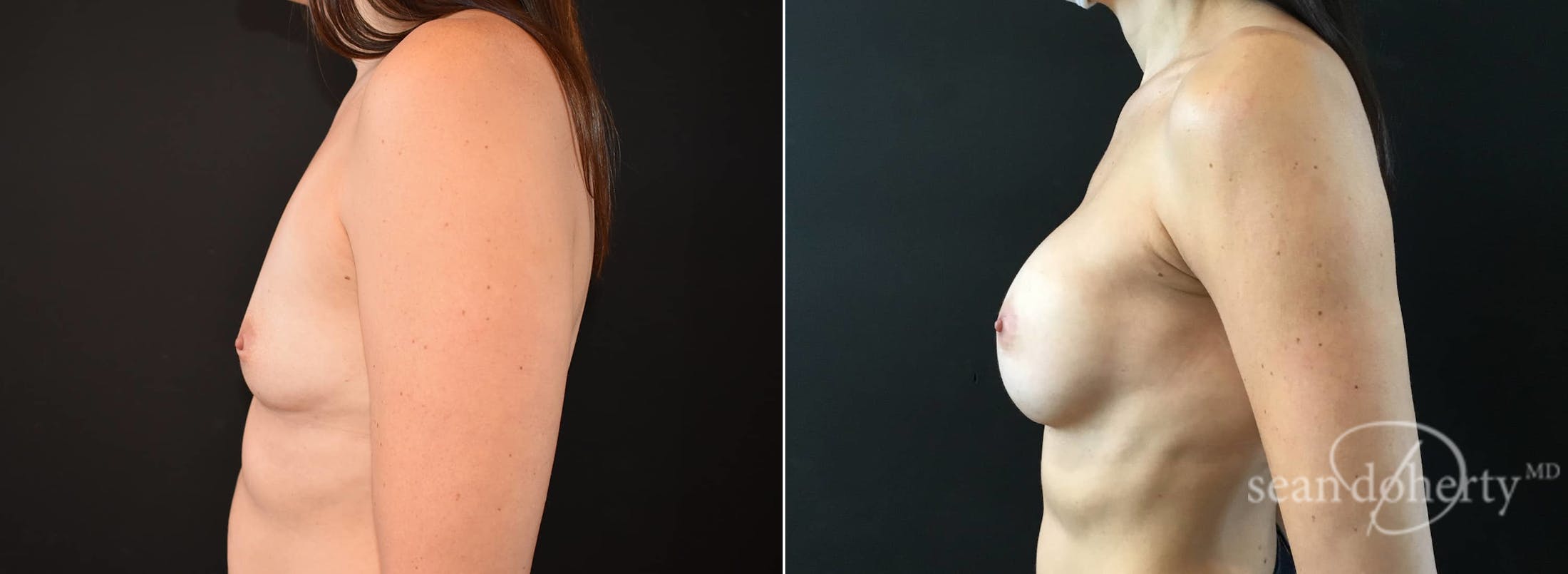 Breast Augmentation Before & After Gallery - Patient 407708 - Image 3