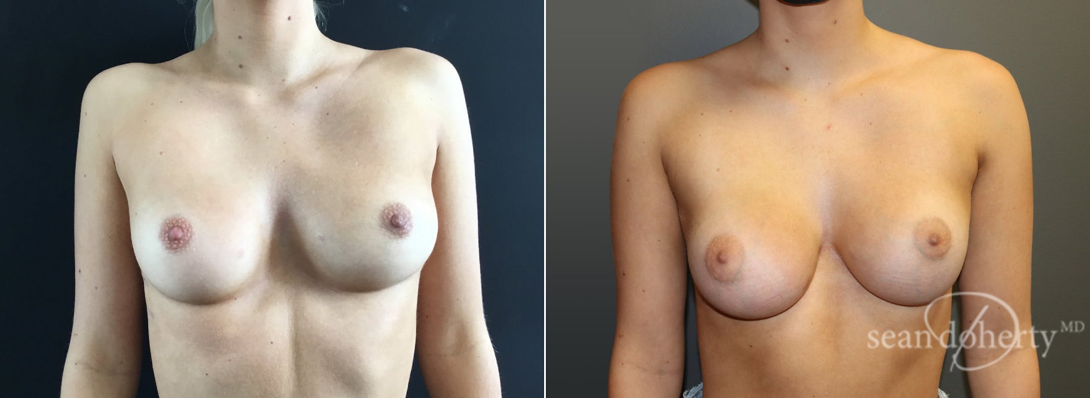 Breast Augmentation Before & After Gallery - Patient 167785 - Image 1
