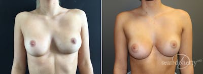 Breast Augmentation Before & After Gallery - Patient 167785 - Image 1