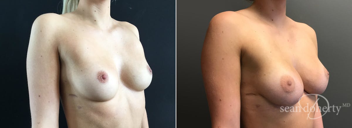 Breast Augmentation Before & After Gallery - Patient 167785 - Image 2