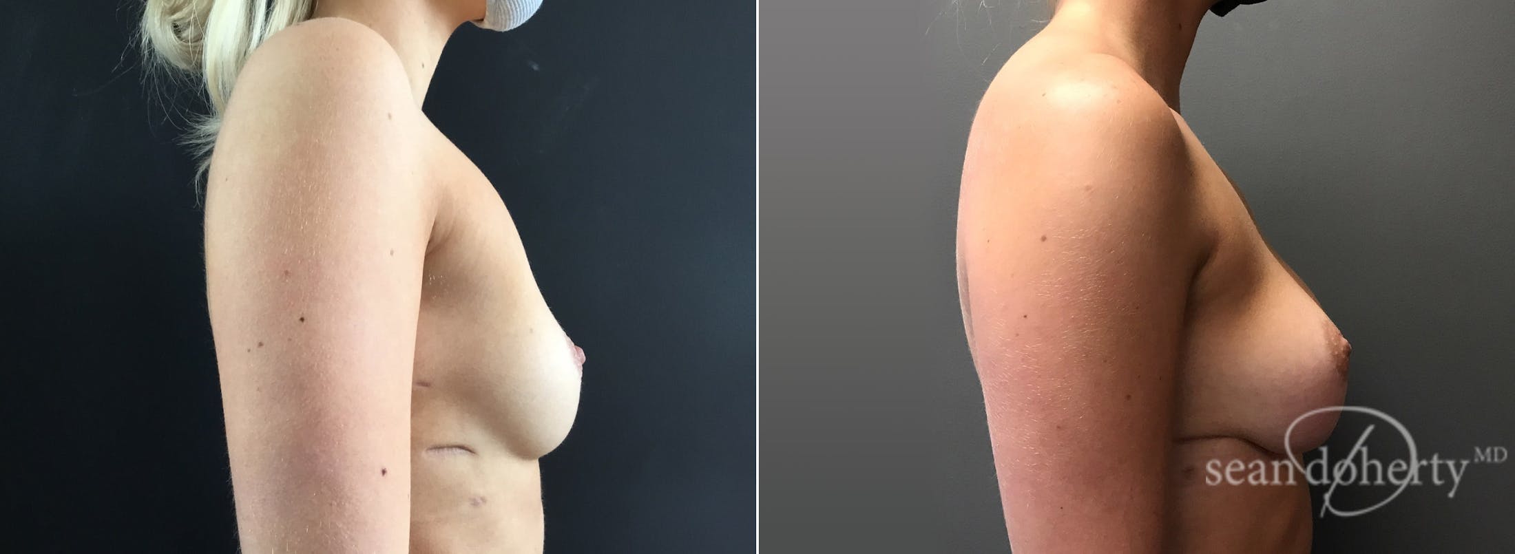 Breast Augmentation Before & After Gallery - Patient 167785 - Image 3