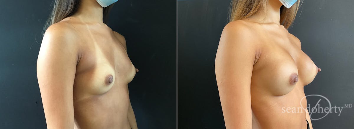 Breast Augmentation  Before & After Gallery - Patient 289413 - Image 2