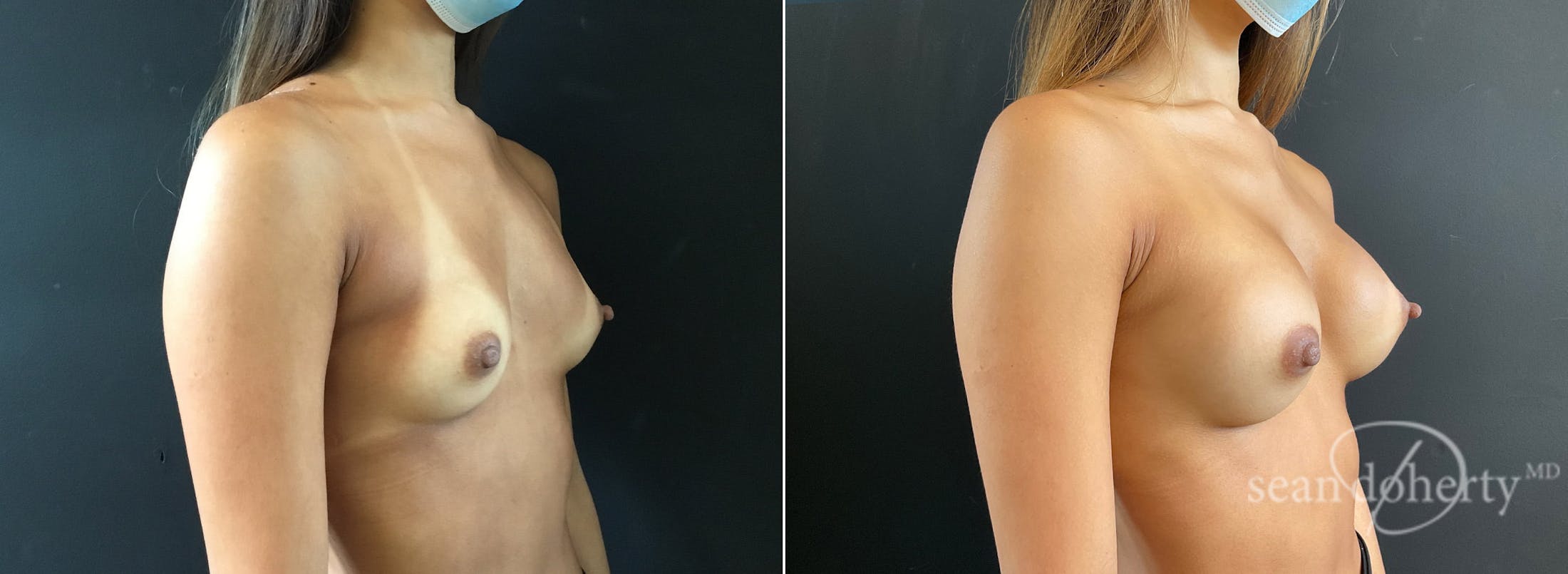 Breast Augmentation Before & After Gallery - Patient 289413 - Image 2