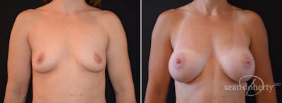 Breast Augmentation Before & After Gallery - Patient 354446 - Image 1
