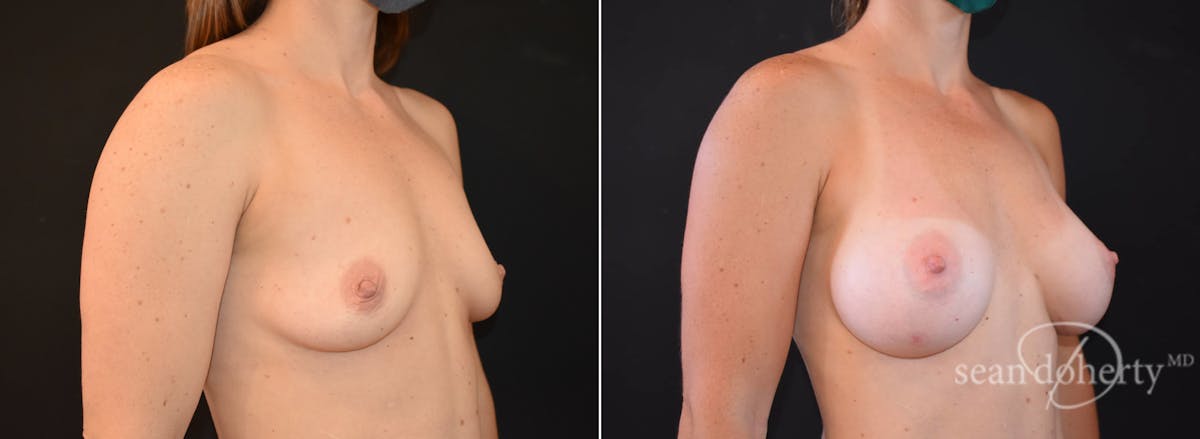 Breast Augmentation  Before & After Gallery - Patient 354446 - Image 2