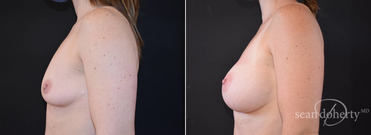 Breast Augmentation  Before & After Gallery - Patient 354446 - Image 3