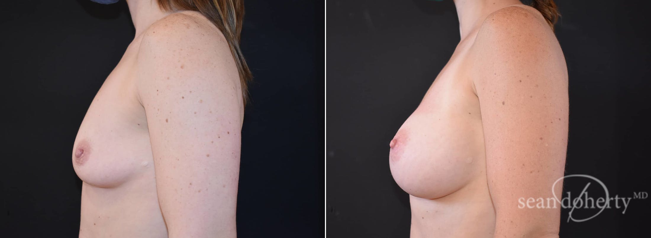 Breast Augmentation Before & After Gallery - Patient 354446 - Image 3