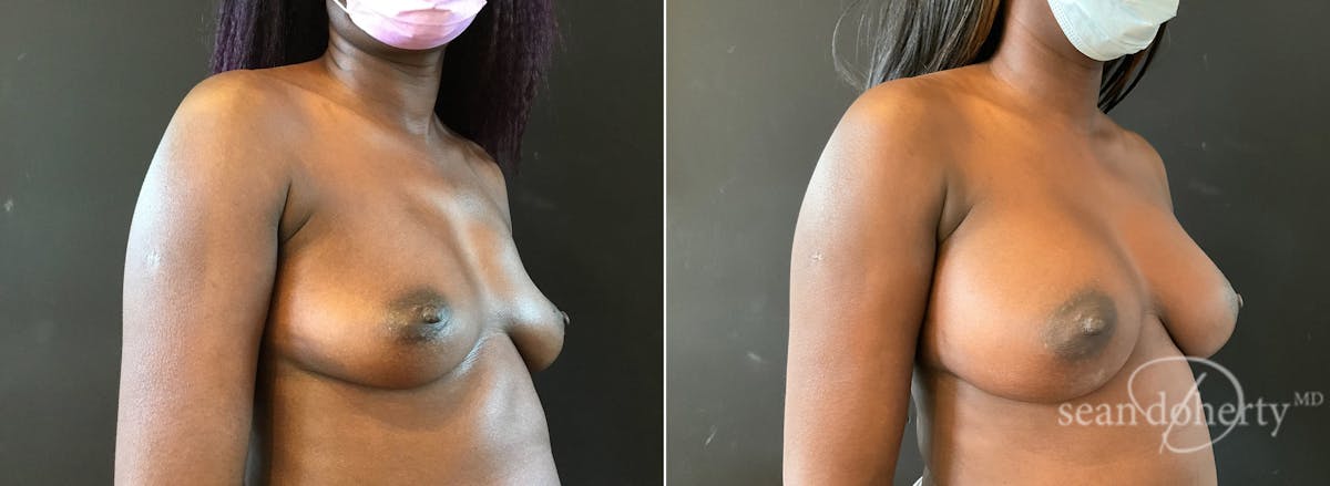 Breast Augmentation  Before & After Gallery - Patient 642793 - Image 2