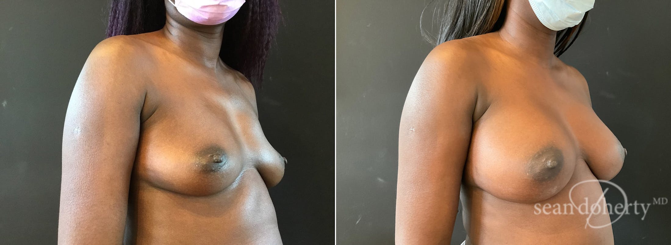 Breast Augmentation Before & After Gallery - Patient 642793 - Image 2