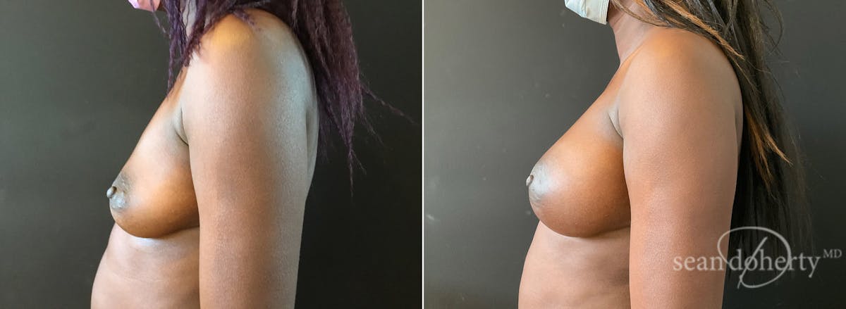 Breast Augmentation  Before & After Gallery - Patient 642793 - Image 3