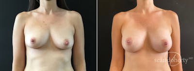 Breast Augmentation Before & After Gallery - Patient 275823 - Image 1