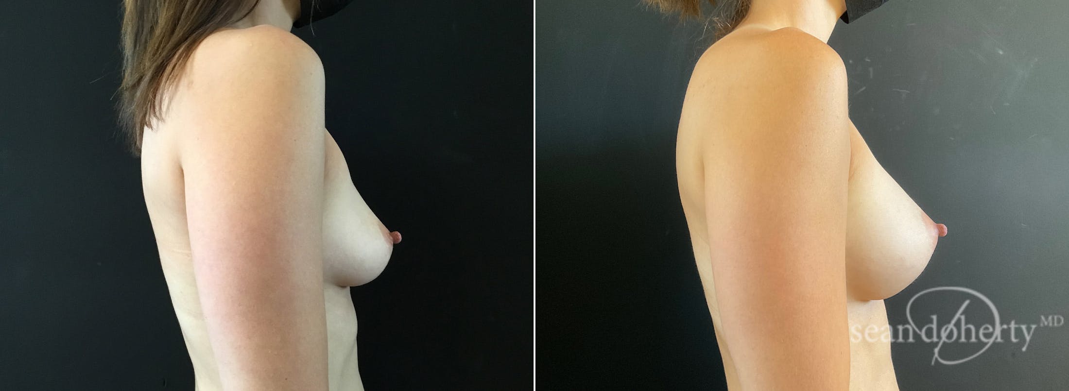 Breast Augmentation Before & After Gallery - Patient 275823 - Image 3