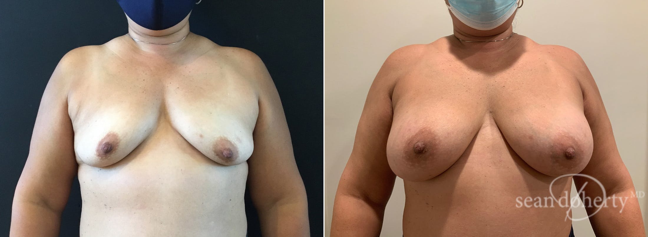 Breast Augmentation Before & After Gallery - Patient 264015 - Image 1