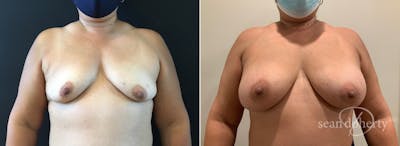 Breast Augmentation Before & After Gallery - Patient 264015 - Image 1