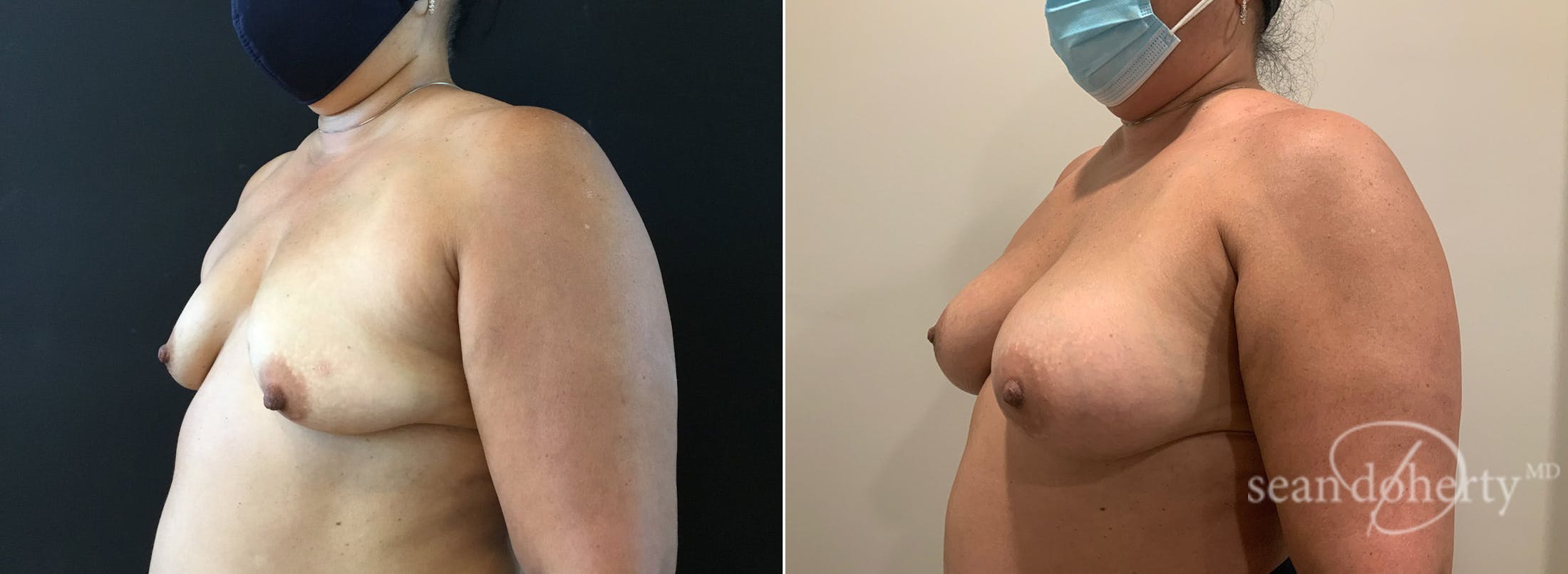 Breast Augmentation Before & After Gallery - Patient 264015 - Image 2