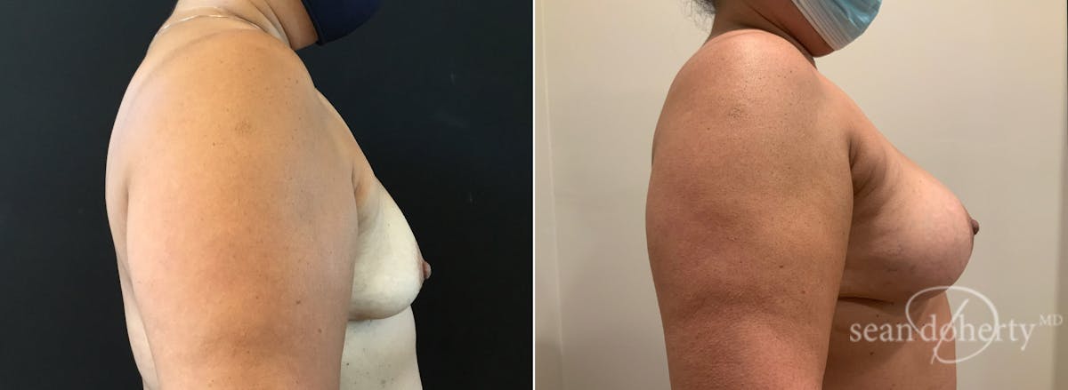 Breast Augmentation  Before & After Gallery - Patient 264015 - Image 3