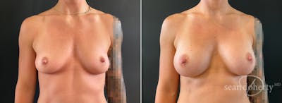 Breast Augmentation Before & After Gallery - Patient 265294 - Image 1