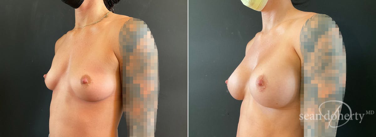 Breast Augmentation Before & After Gallery - Patient 265294 - Image 2