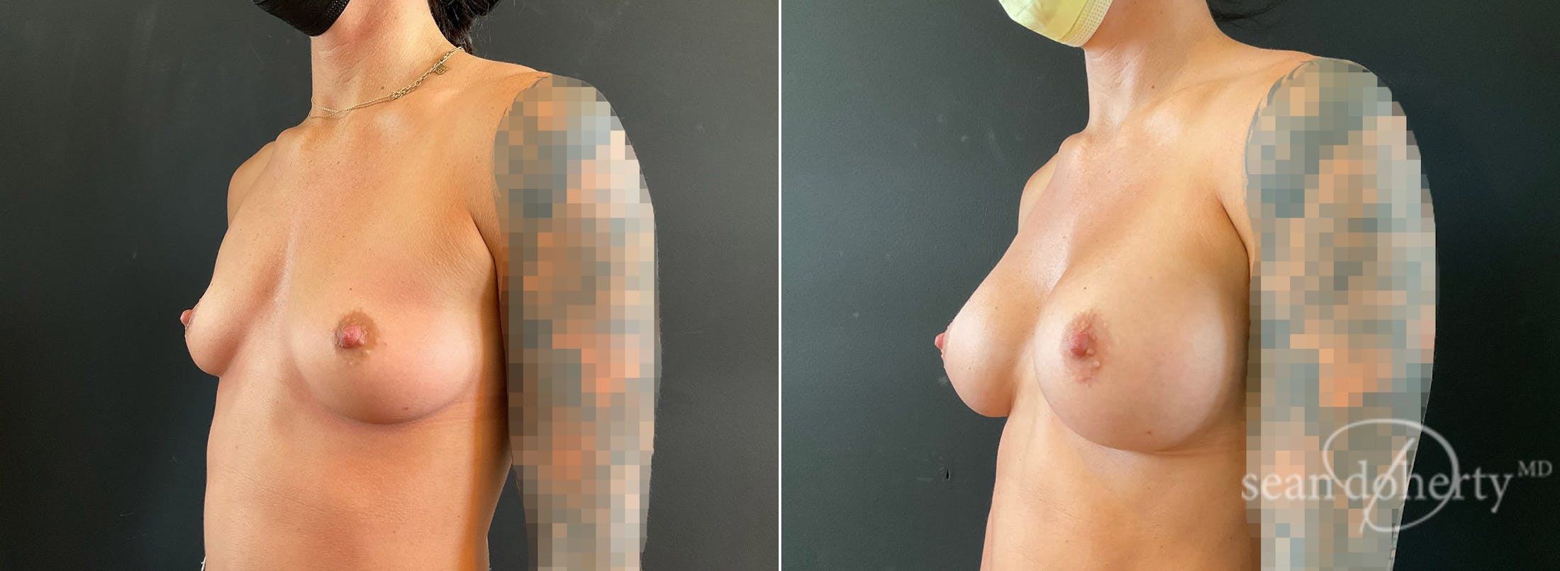 Breast Augmentation Before & After Gallery - Patient 265294 - Image 2