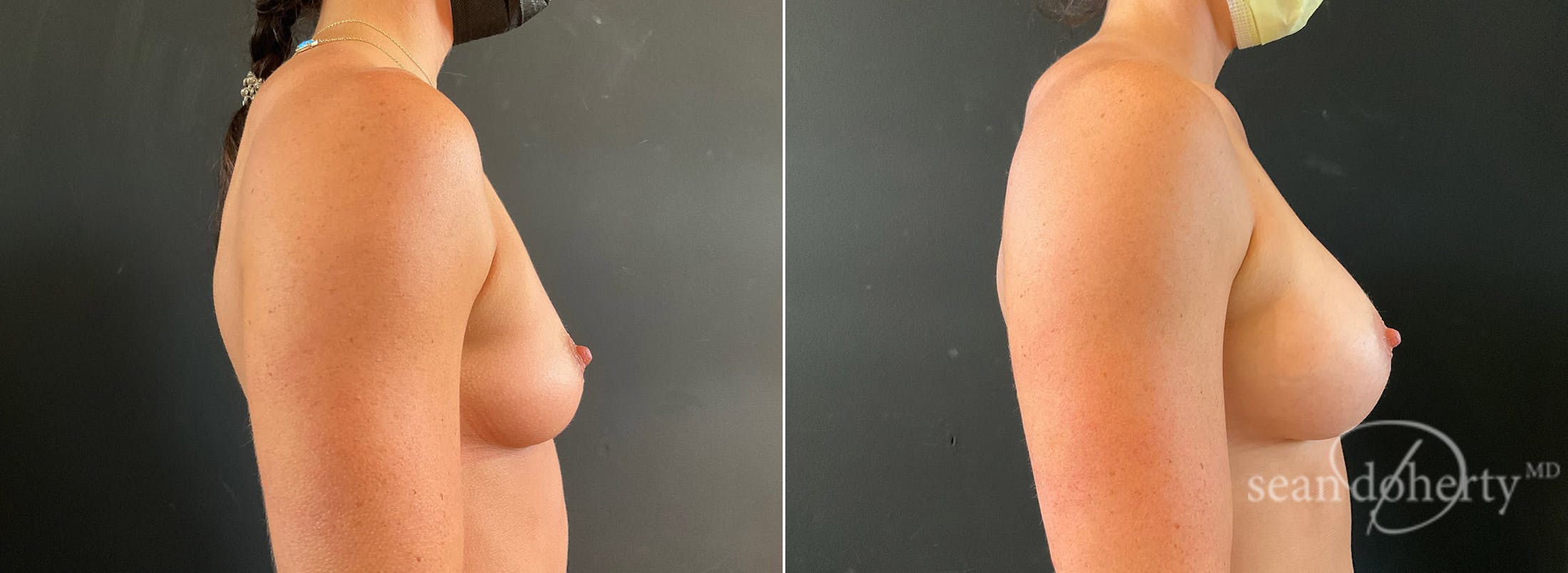 Breast Augmentation Before & After Gallery - Patient 265294 - Image 3