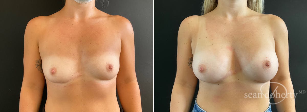Breast Augmentation  Before & After Gallery - Patient 281883 - Image 1