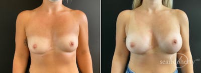Breast Augmentation Before & After Gallery - Patient 281883 - Image 1