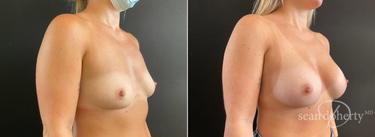 Breast Augmentation  Before & After Gallery - Patient 281883 - Image 2