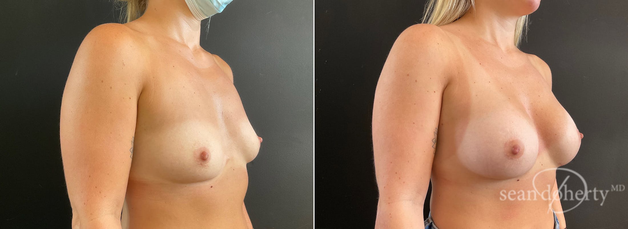 Breast Augmentation Before & After Gallery - Patient 281883 - Image 2