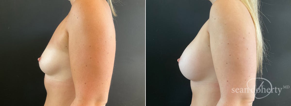 Breast Augmentation  Before & After Gallery - Patient 281883 - Image 3