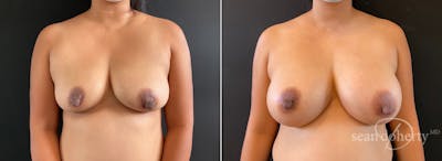 Breast Augmentation Before & After Gallery - Patient 311480 - Image 1