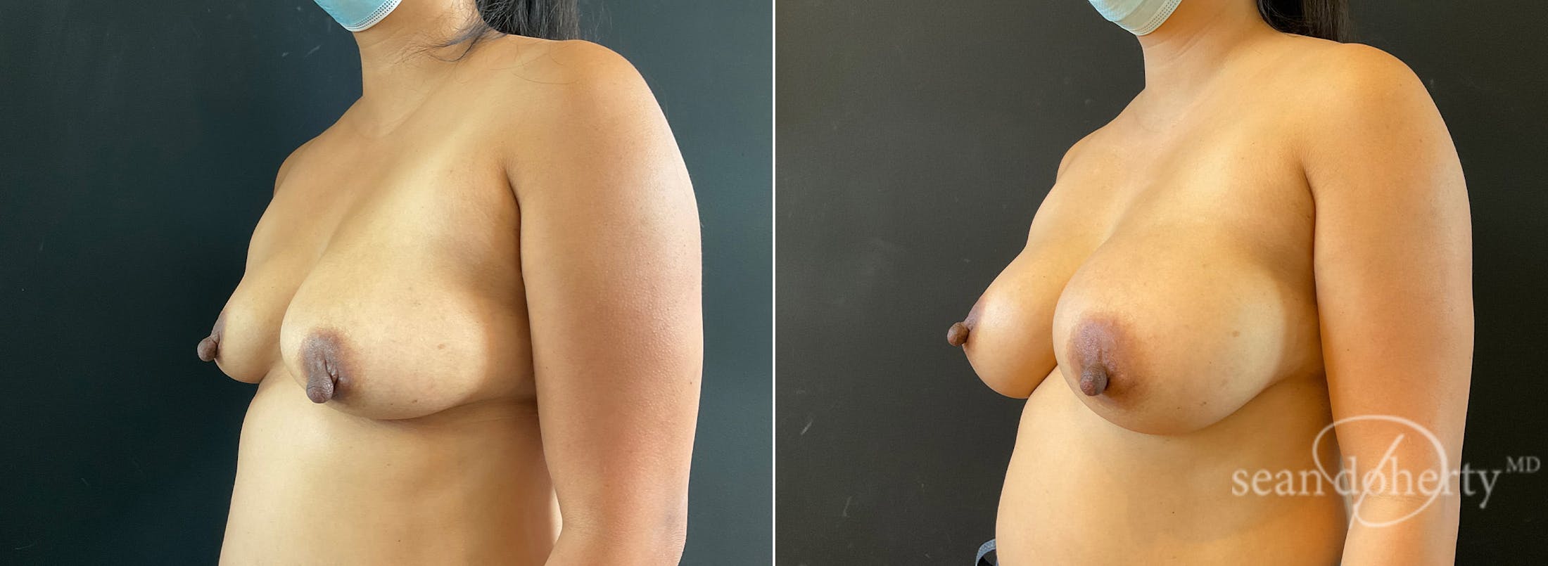 Breast Augmentation Before & After Gallery - Patient 311480 - Image 2