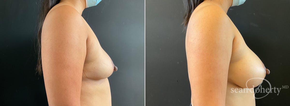 Breast Augmentation Before & After Gallery - Patient 311480 - Image 3