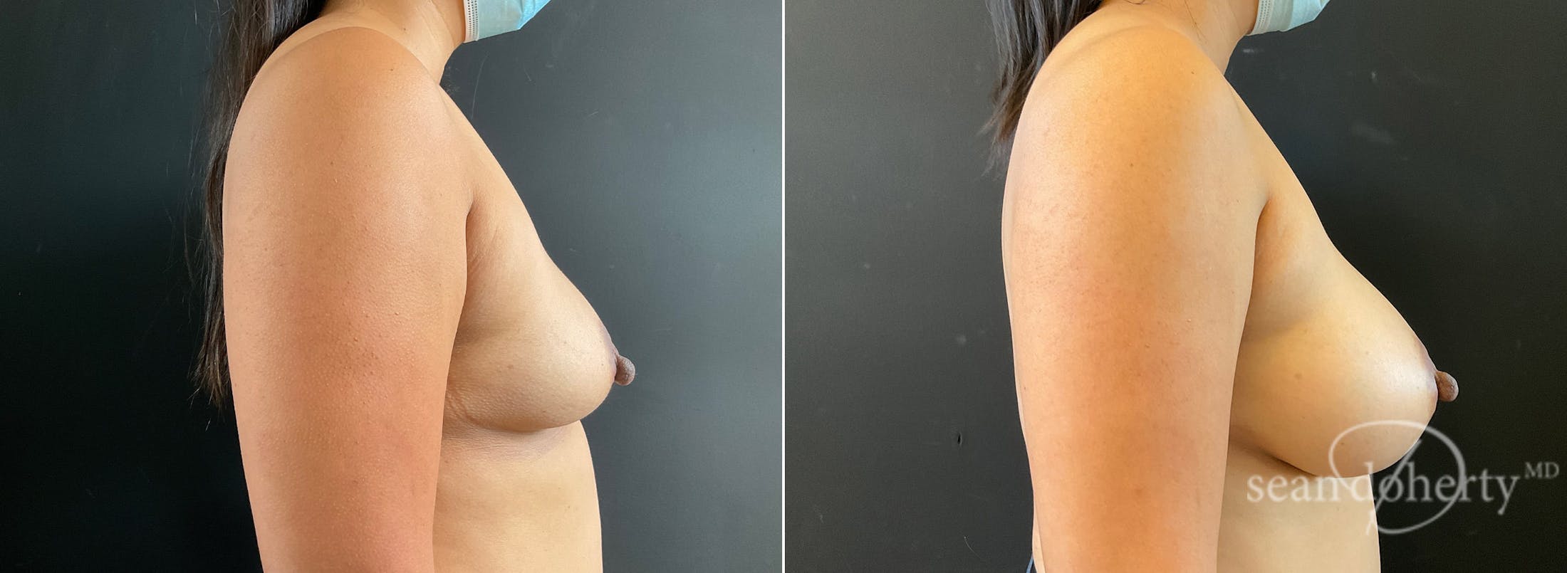 Breast Augmentation Before & After Gallery - Patient 311480 - Image 3