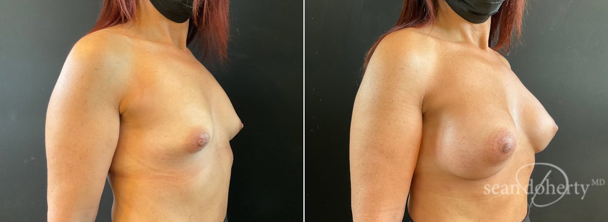 Breast Augmentation Before & After Gallery - Patient 257601 - Image 2