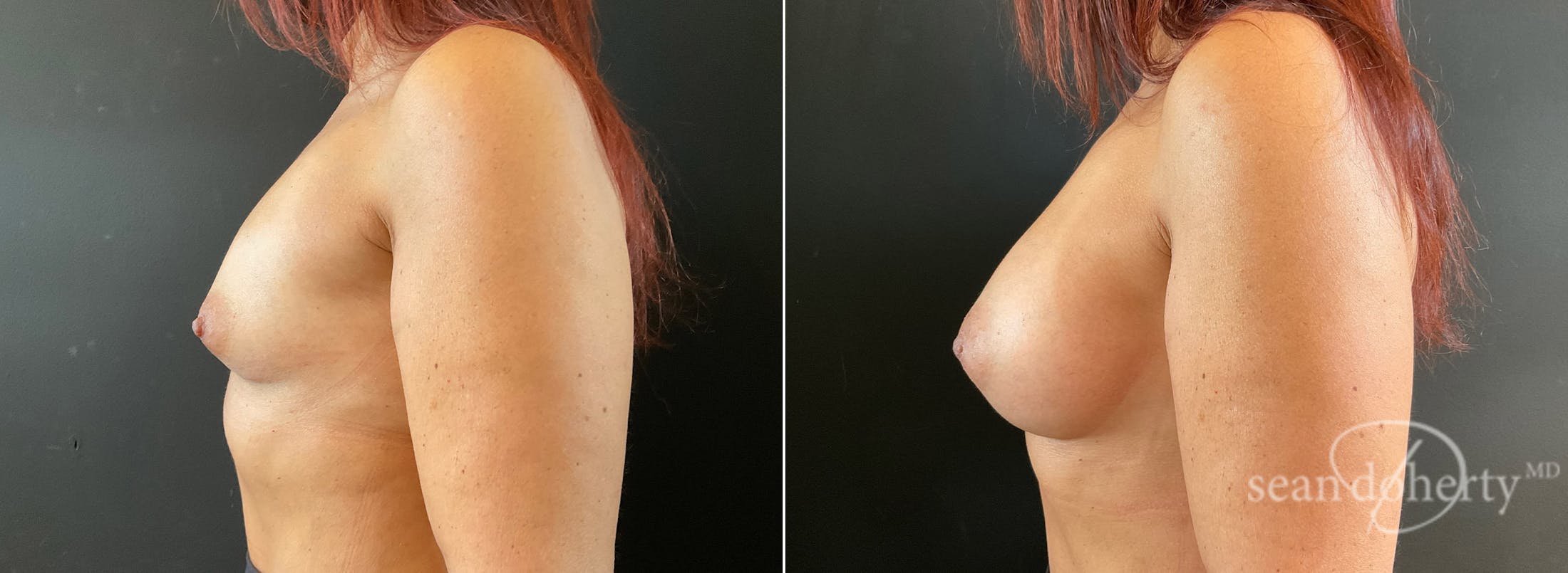 Breast Augmentation Before & After Gallery - Patient 257601 - Image 3